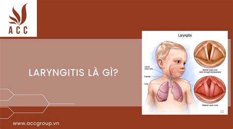 laryngitis là gì